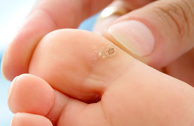 Jak poznat a účinně léčit bradavice. Tyto rady vám pomohou