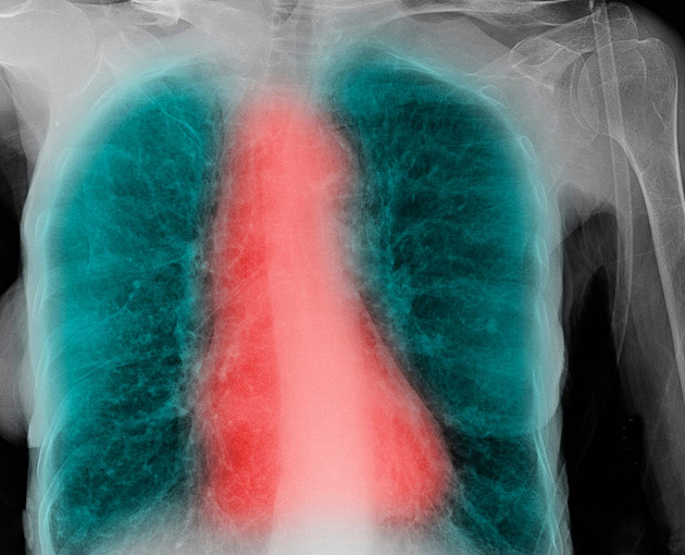 Smrtící kombinace. Nemocí plic a zástavou dechu trpí stovky tisíc lidí, často to netuší