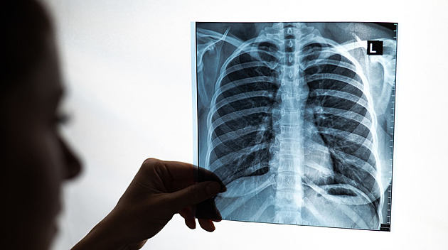 Češi nevyužívají možnosti včasného záchytu rakoviny. Brzdí je strach i stud